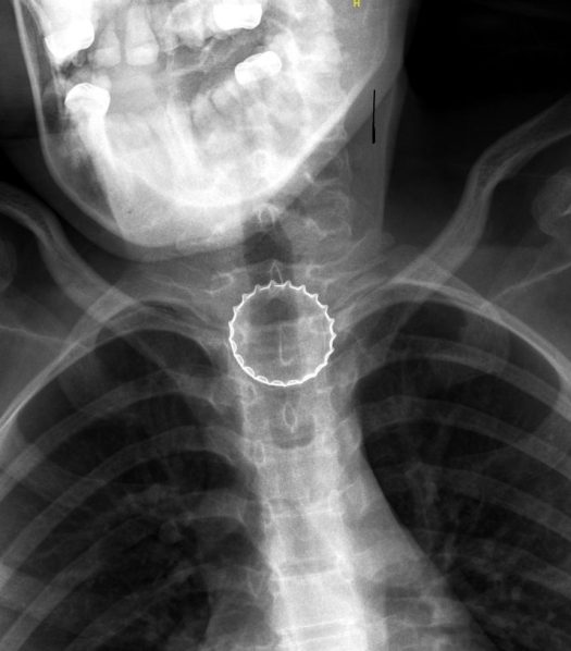 צילום רנטגן בו ניתן לראות את הפקק בוושט
